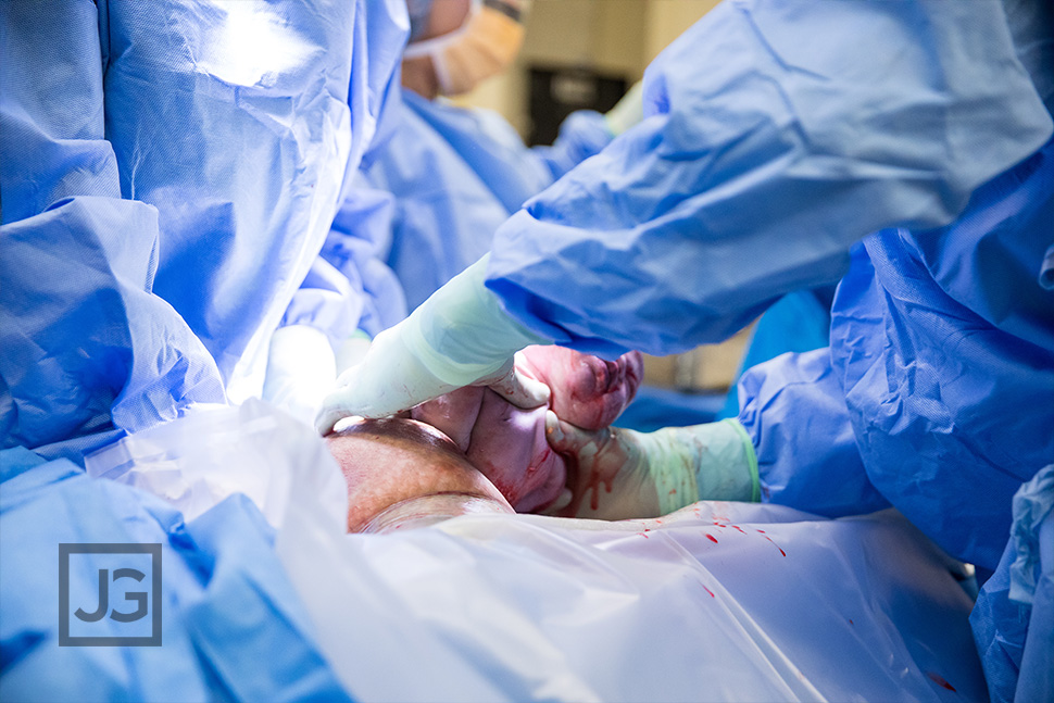 birth photography c-section surgery